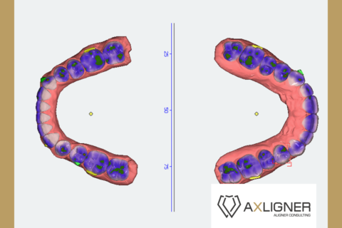 Ocena cyfrowego planu leczenia nakładkami może być wykonana w gronie lekarzy doświadczonych w leczeniu alignerami. Zapraszamy na konsultacje.