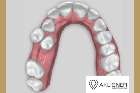 duza wada zgryzu pacjenta do leczenia nakladkami ortodontycznymi konsultacja