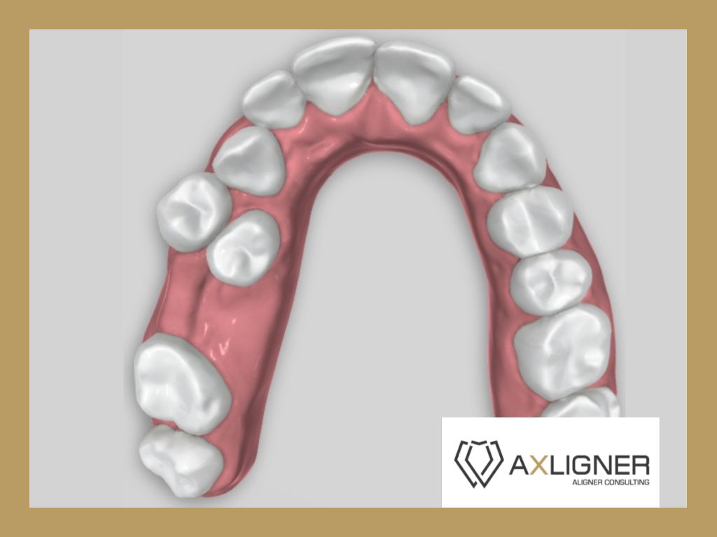 duza wada zgryzu pacjenta do leczenia nakladkami ortodontycznymi konsultacja